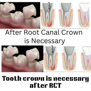 Tooth crown is necessary after RCT_20250614_053817_0000